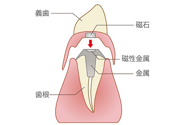 磁性アタッチメント義歯