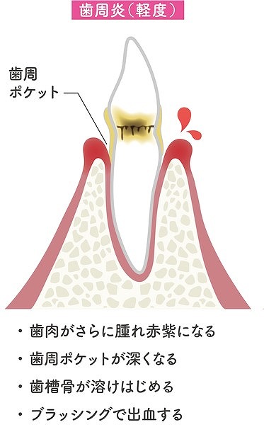 軽度歯周炎