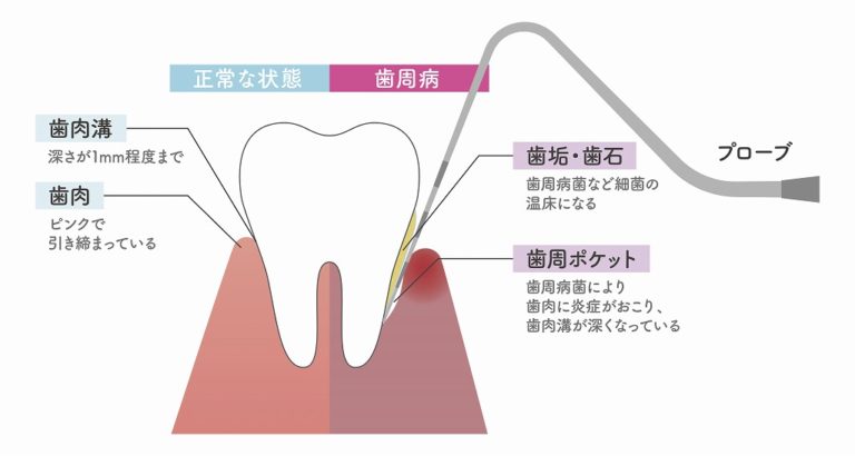 基本的な歯周病検査