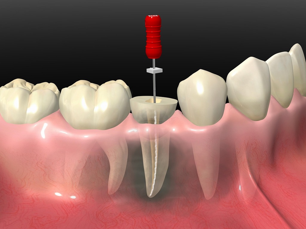 歯を抜かずに残す歯の神経の治療（根管治療）