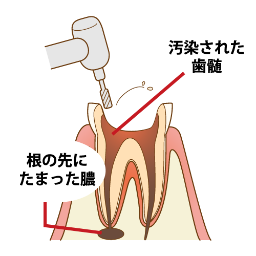 むし歯の除去と根管の入り口の確保