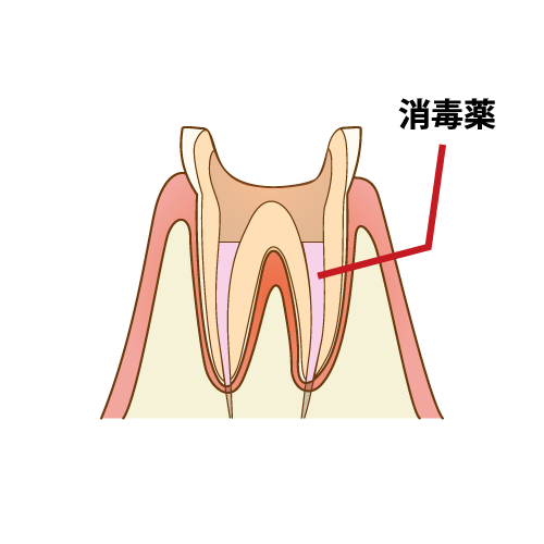 根管の消毒・殺菌