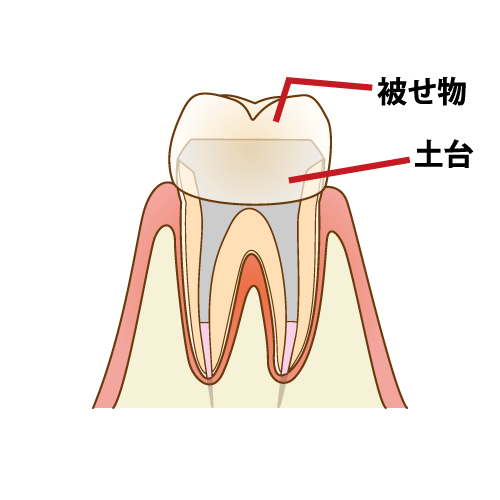 被せ物で歯冠を補う
