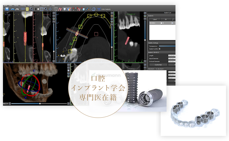 博多でインプラント