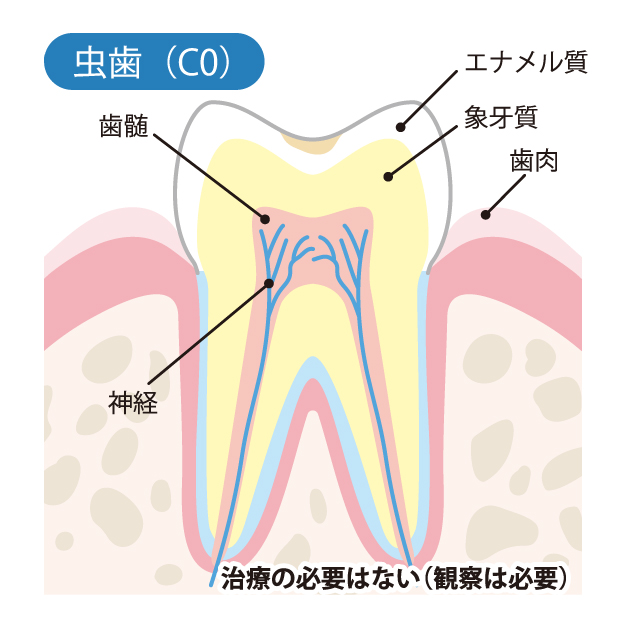 CO脱灰