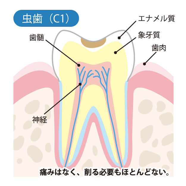 C１エナメル質のむし歯