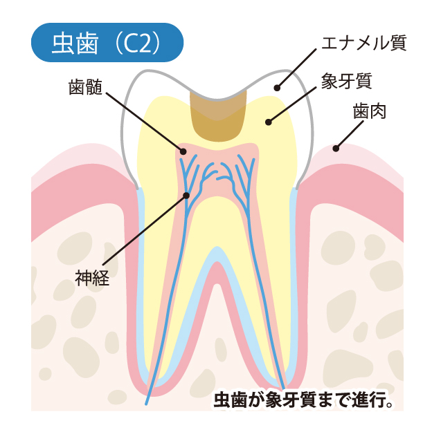 C2象牙質のむし歯