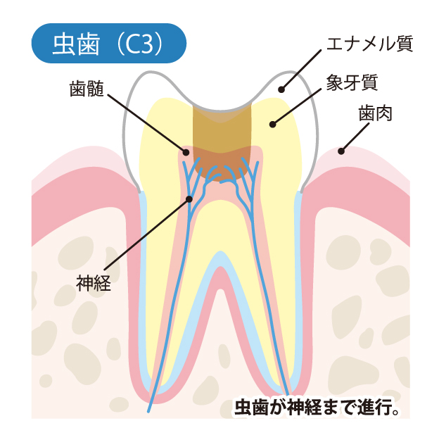 C３歯の神経に達したむし歯