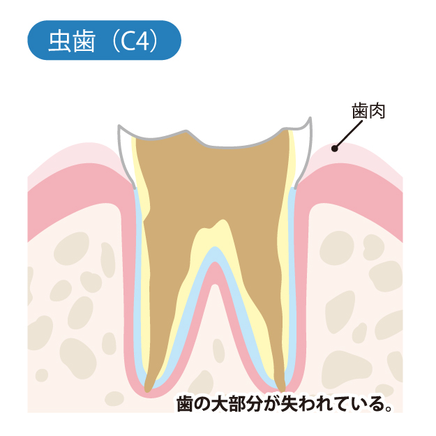 C4神経が壊死した状態